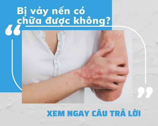 Bị vảy nến có chữa được không?